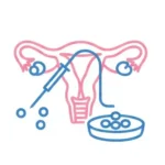 Egg Retrieval Procedure