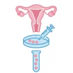 In Vitro Fertilization (IVF)