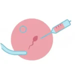 Intracytoplasmic Sperm Injection (ICSI)